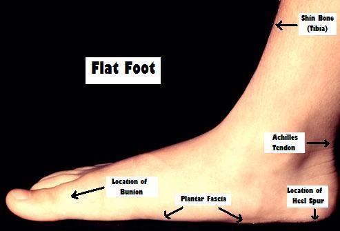 Acquired Flat Foot