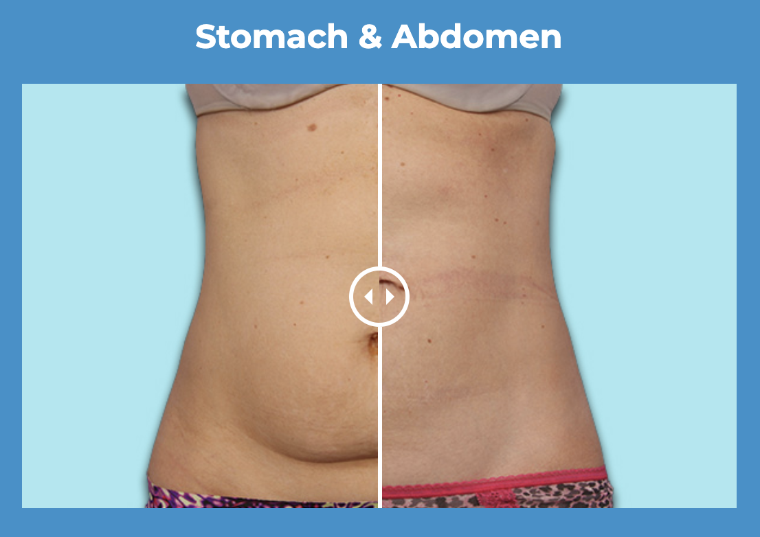 CoolSculpting Clinic at The Derm Photo