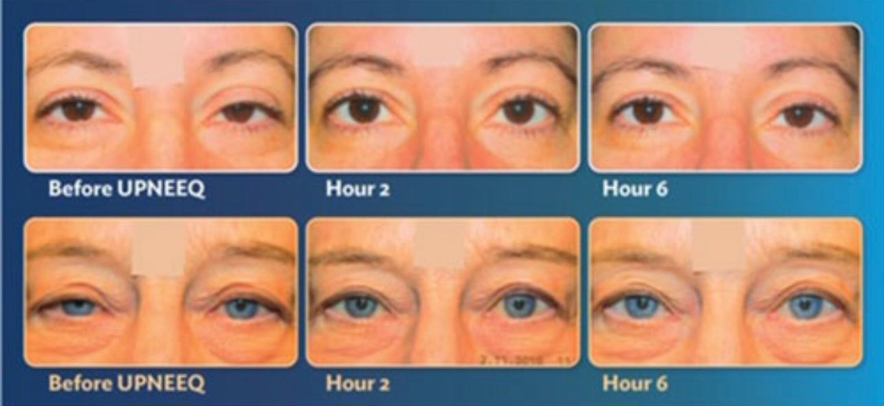 Non-Surgical Eye lid lift