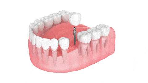 Dental Implants