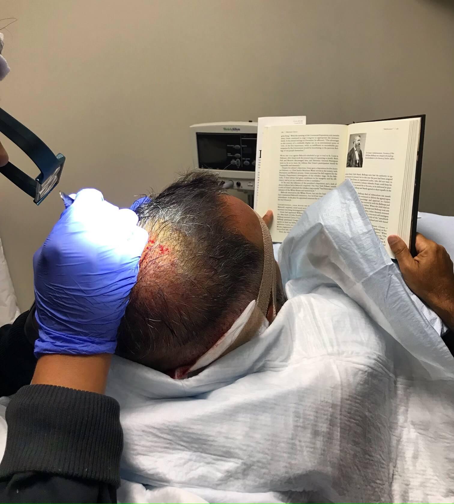 Neograft Hair Restoration Orange County