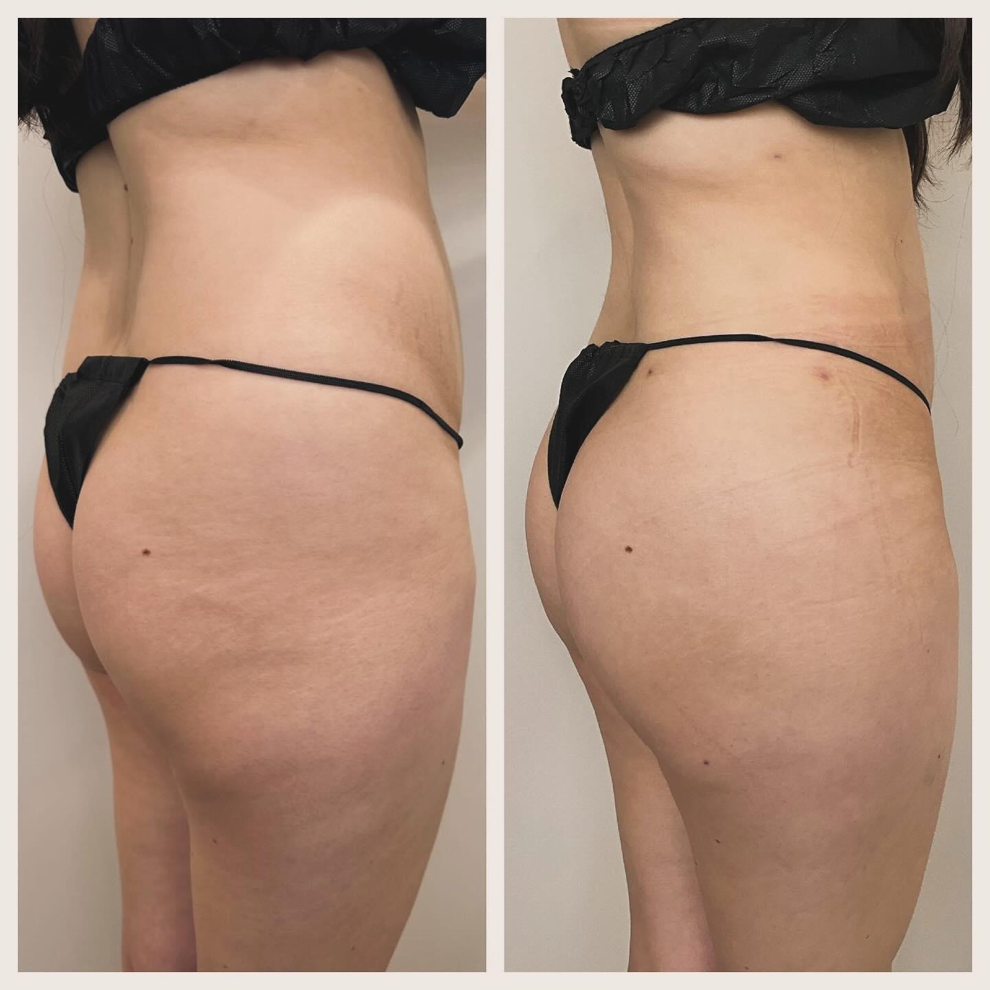 BodyLuxe | FormSculpt Awake Liposuction & Fat Transfer by Daniel J Farrugia MD PhD FACS Image
