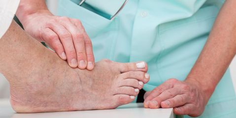 3 Reasons You May Have Bunions