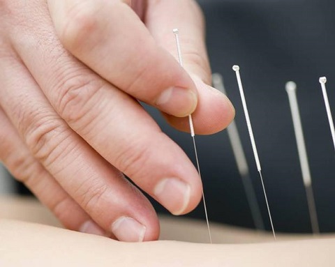 NEUROSPORT Acupuncture Photo
