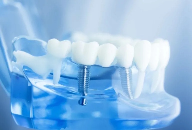 Dental Crowns