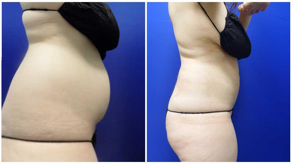 Denver Liposuction Specialty Clinic Photo