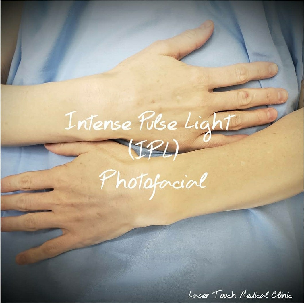 Goodbye age or sun spots, acne scarring, red blemishes and fine lines...hello beautiful skin! . ââ##BULLET##ï¸Treatment: Intense Pulse Light (IPL Photofacial) Purpose: Reduce the appearance of red blemishes, acne scarring, pigmentation, sun spots and fine lines in the face, neck, chest, arms and hands Anesthesia: Topical, if needed Procedure Time: 30- 45 minutes âResults: Because of the gentle nature of the procedure multiple treatments (4-6) are recommended for the maximum possible reaults Pain Level: Varies, very mild to mild Notes: Individual results may vary â