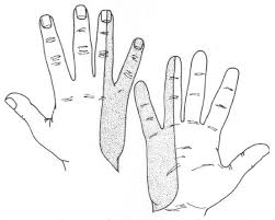 Ulnar Neuropathy The Ulnar nerve runs all the way from the neck, through the elbow and into the pinky and ring fingers. Along the way there are many opportunities for the nerve to be pinched causing pain, numbness, tingling and weakness to those areas. This week we will discuss the various ulnar neuropathies that affect the distal wrist. There are four different types of neuropathy that may affect the distal aspect of the wrist. The first type of neuropathy is where an individual will produce a weakened grip in the hands. They may not be able to hold objects as tight as before. Second, would produce the same symptoms, but severe grip weakness and an inability to keep the fingers apart. Third, again, will cause weakness of all the ulnar intrinsic muscles in the hand and an individual will experience impaired sensation at the palm side of the hand. The last type of neuropathy involves hand grip will be normal, but there will be impaired sensation at the palm side of the hand. In addition to ulnar neuropathies, there are many reasons that one can experience pain, numbness, tingling and weakness in the hands such as diabetic neuropathy, ganglion cysts, pinched nerve in the neck, shoulder, arm or hand. Electrodiagnostic Studies is an excellent tool to localize the problem area. There are two parts in Electrodiagnostic studies, Nerve Conduction Study and Electromyography. For any questions or problems, you can contact Dr. Kamran Hakimian at California Sports & Rehab Center at (310) 652-6060 or visit our website at http://emg-ncv.com. We can accommodate your needs in one of our convenient locations in the Los Angeles and Orange County areas.