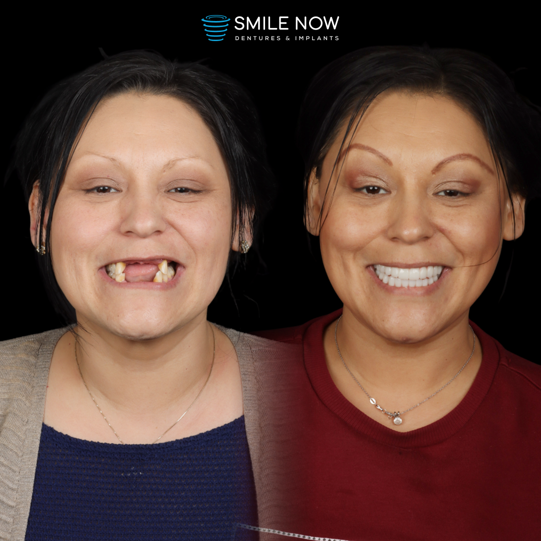 Smile Now Boise Dentures and Implants Image
