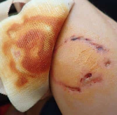 Dog Bite Injury