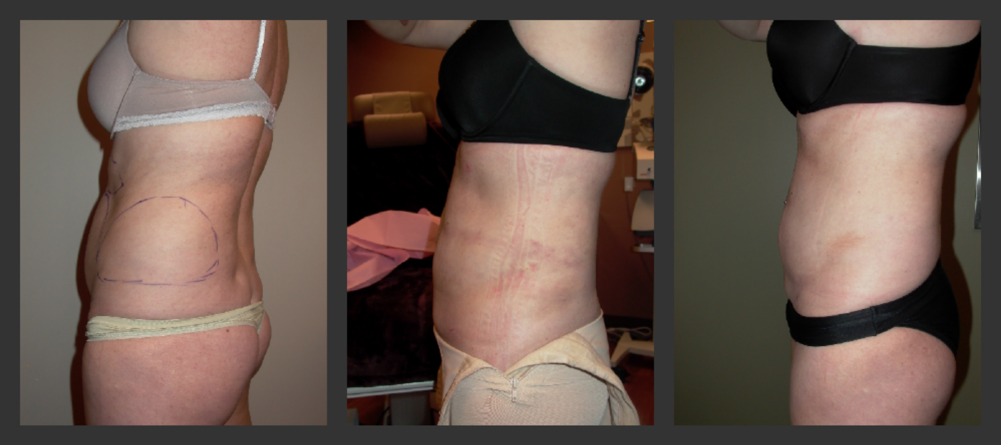 Tickle Lipo