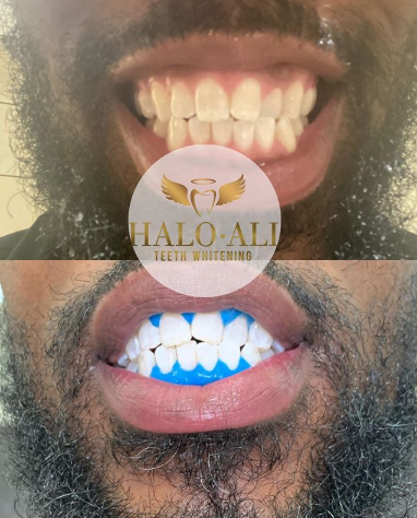 Halo Ali Teeth Whitening Photo