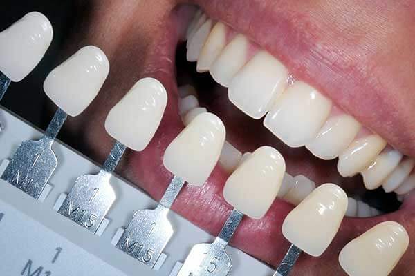 Dental Veneers
