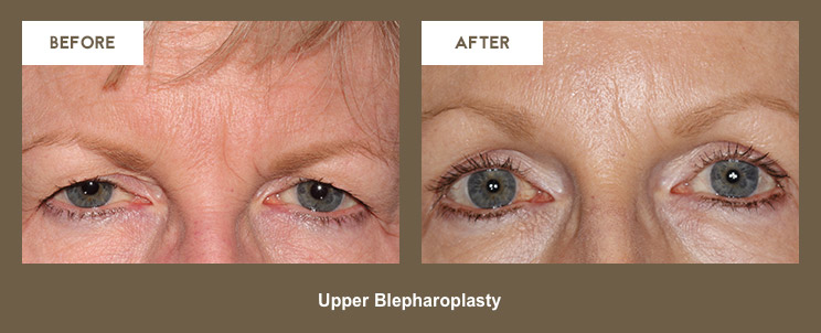 Klapper Eyelid and Facial Plastic Surgery Photo