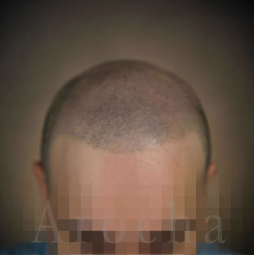 Scalp Micropigmentation