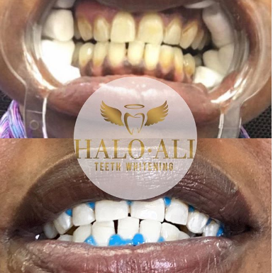 Halo Ali Teeth Whitening Photo