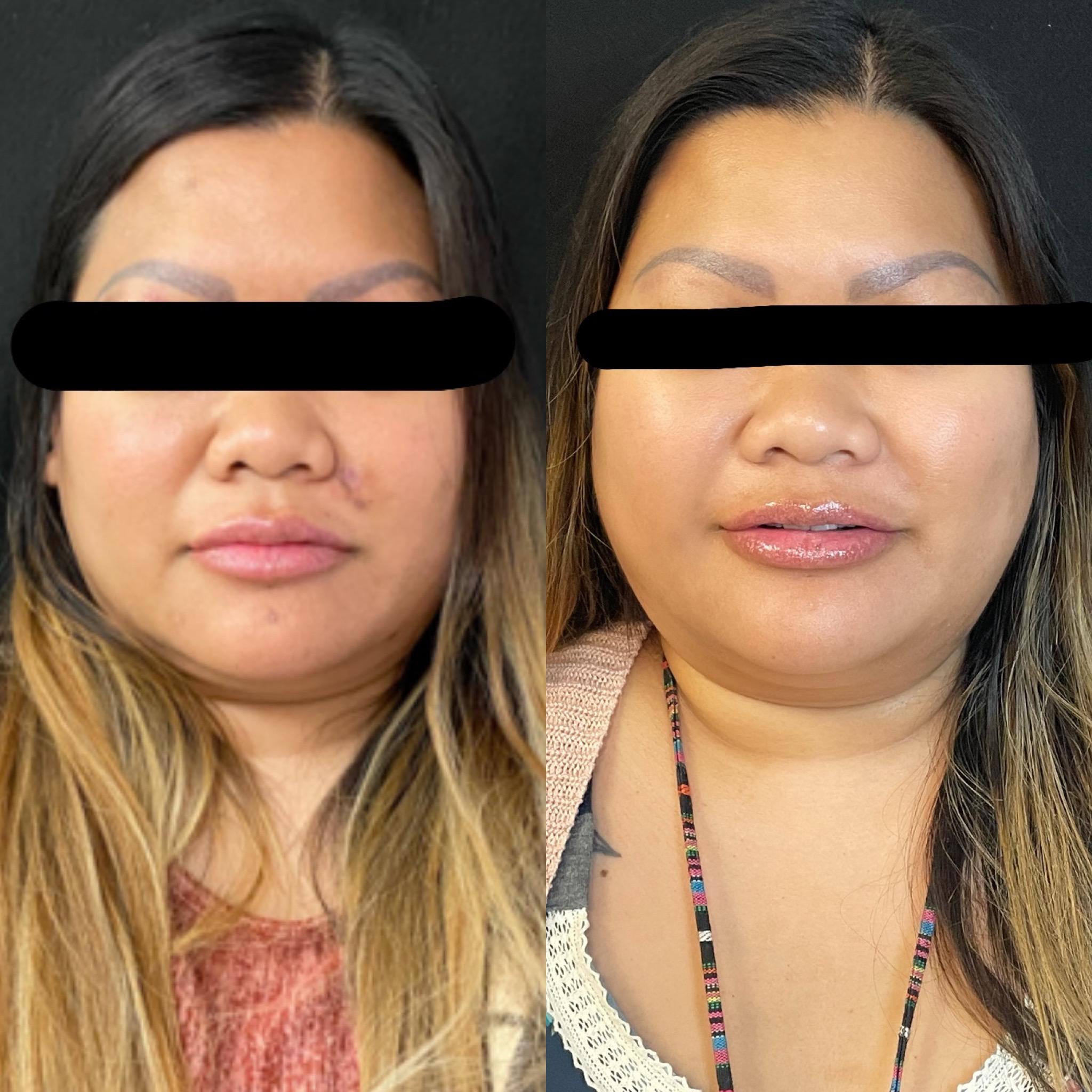 Post one month of ZO 3 Step Peel