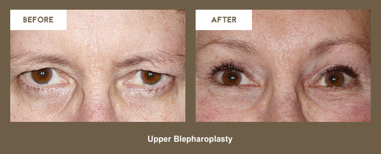 Klapper Eyelid and Facial Plastic Surgery Photo