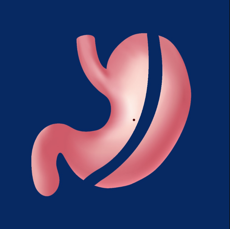 Gastric Sleeve
