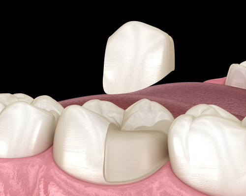 Porcelain Onlays