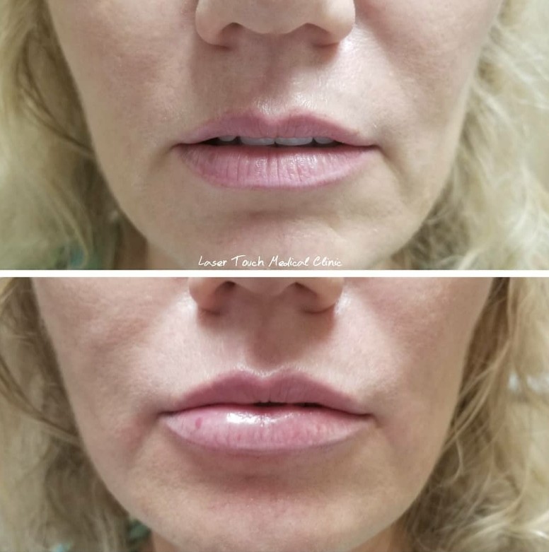 Ready for the holidays!  With just a syringe of  Volbella and one syringe of  JuvedermXC our lovely client was able to define and plump her lips as well as smoothing out her laugh lines . . . ââ##BULLET##ï¸Treatment: JuvedermXC and Volbella dermal fillers Purpose: Plump and define the lips, smooth out laugh lines Anesthesia: Topical Procedure Time: 15- 60 minutes âResults: Immediately Lasts: 7-10 months Pain Level: Varies, very mild to mild Notes: Individual results may vary â