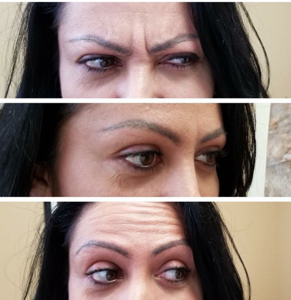 Happy Tuesday! Look calm and get Botox ------------- Wondering how much Botox is right for you? Call us to schedule a consultation!