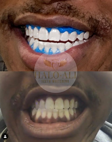 Halo Ali Teeth Whitening Photo