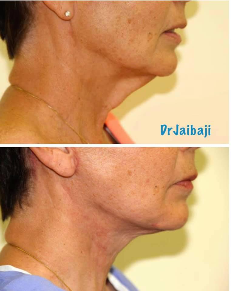 Jaibaji Plastic Surgery Photo