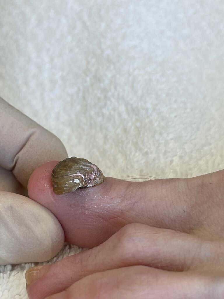 Podologue.CA- Soins de pieds à Lévis