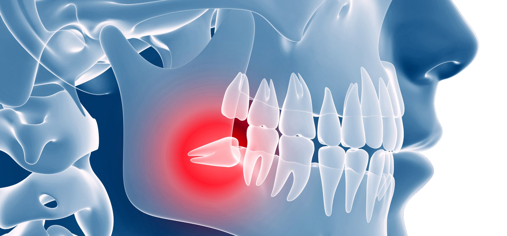 Oralchirurgie, Implantaten