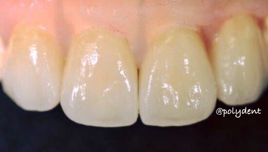 Images Poly-Dent Ceramic