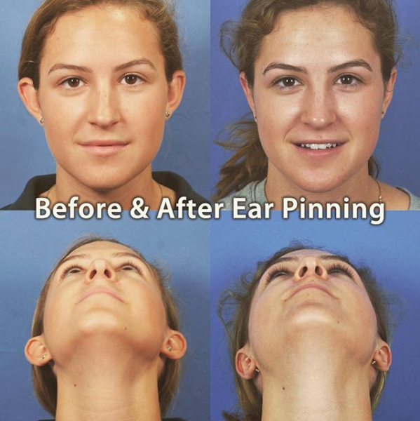 Ear Pinning before and after