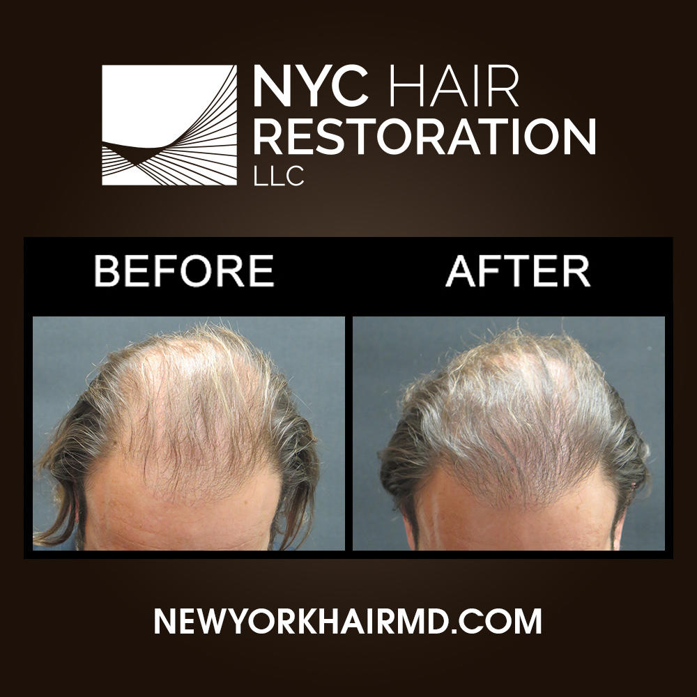 NYC Hair Restoration Photo