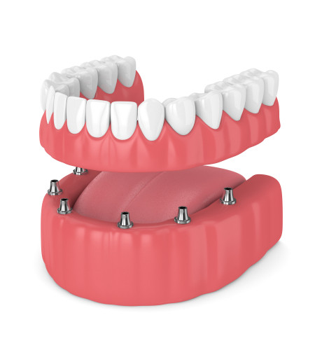 Mini Dental Implants