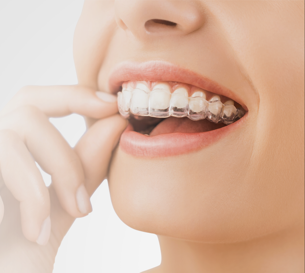 Invisalign®
