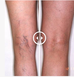 Precision Vein Therapeutics Photo