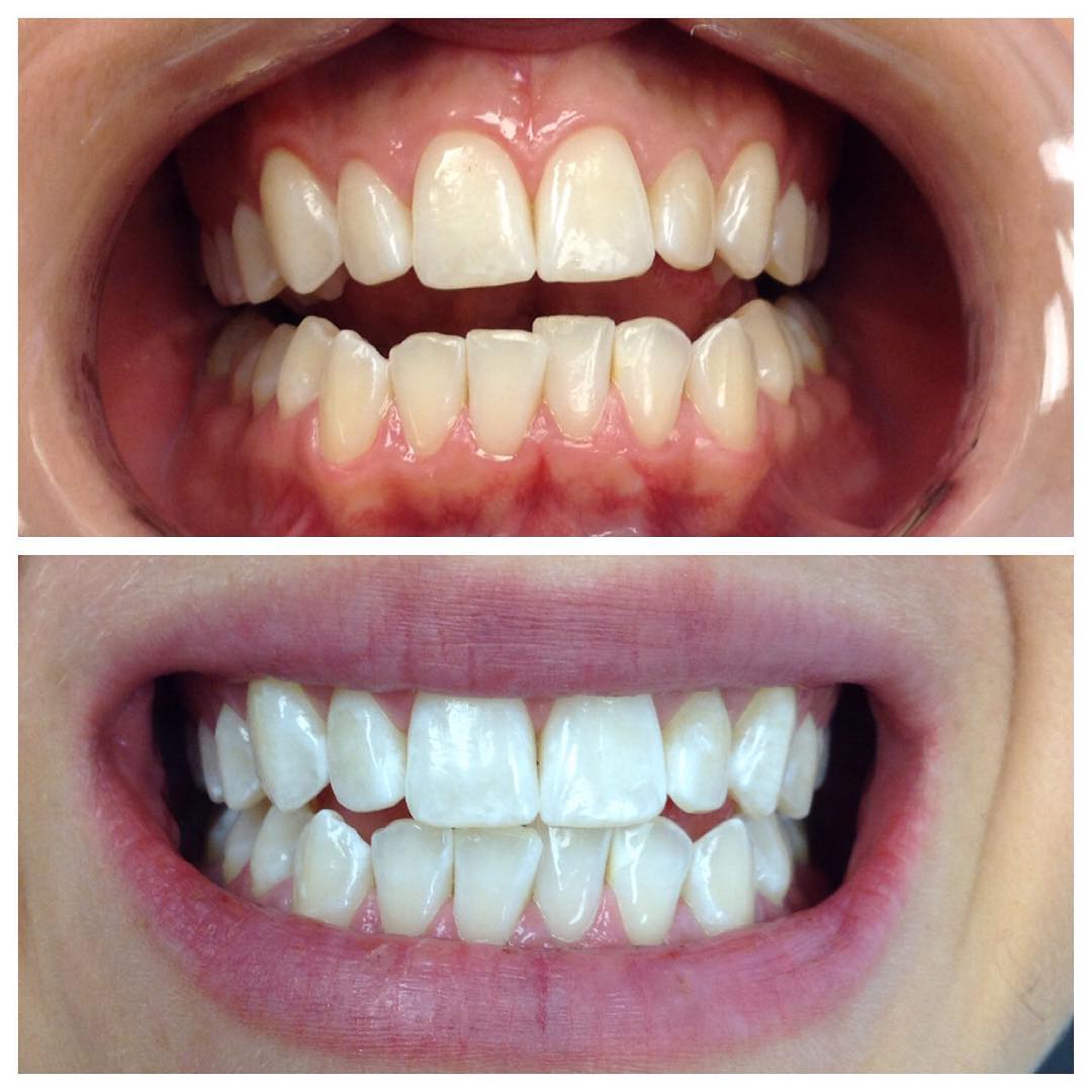 5280 Teeth Whitening Photo