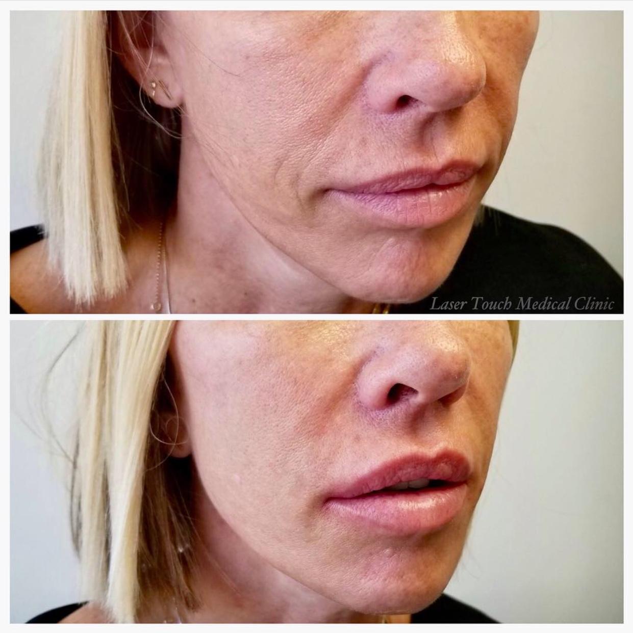 Did you know that after the age of 20, we produce 1% less collagen in our skin each year? Without the production of collagen we are prone to loose volume in our face, hollowness of the cheeks, deep creases, limes and wrinkles start forming around the eyes and mouth and even even deep hollows under the eyes Good thing our client knew about dermal fillers and stopped by our office to target her laugh lines and the hollow under the eyes, in addition to some lip definition!