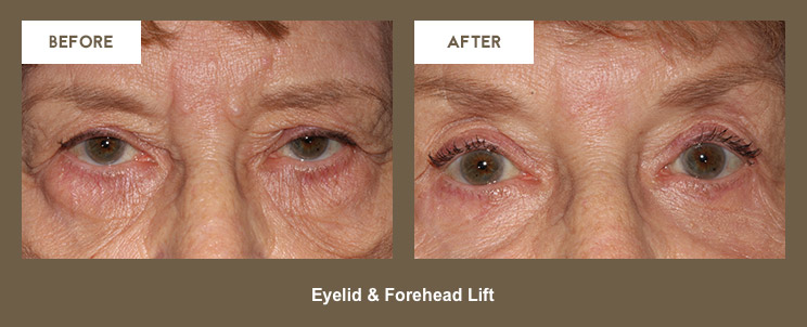 Klapper Eyelid and Facial Plastic Surgery Photo