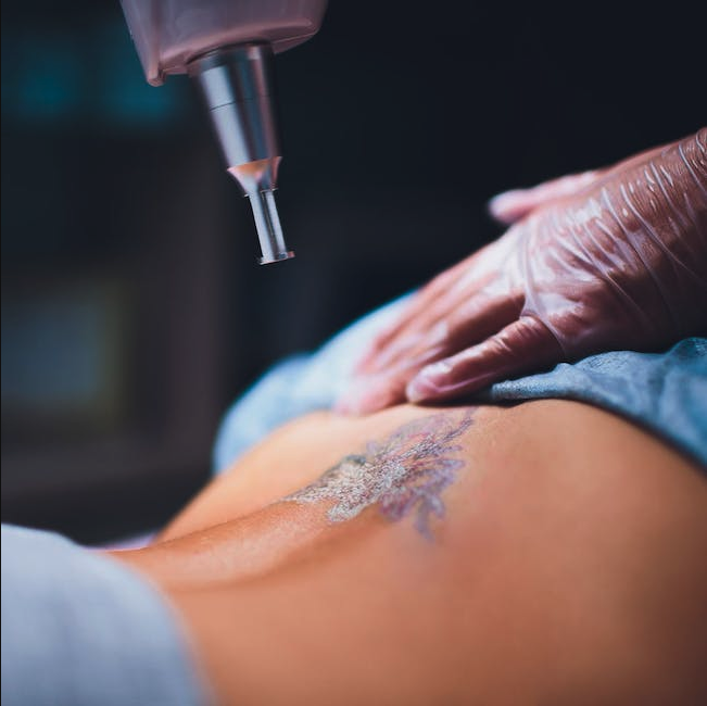 Laser Tattoo Removal