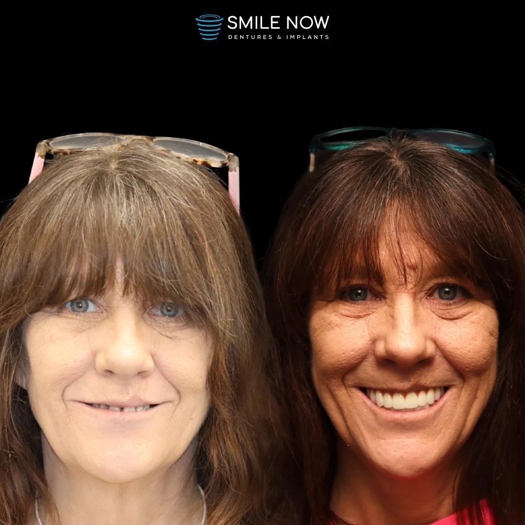 Smile Now Boise Dentures and Implants Image