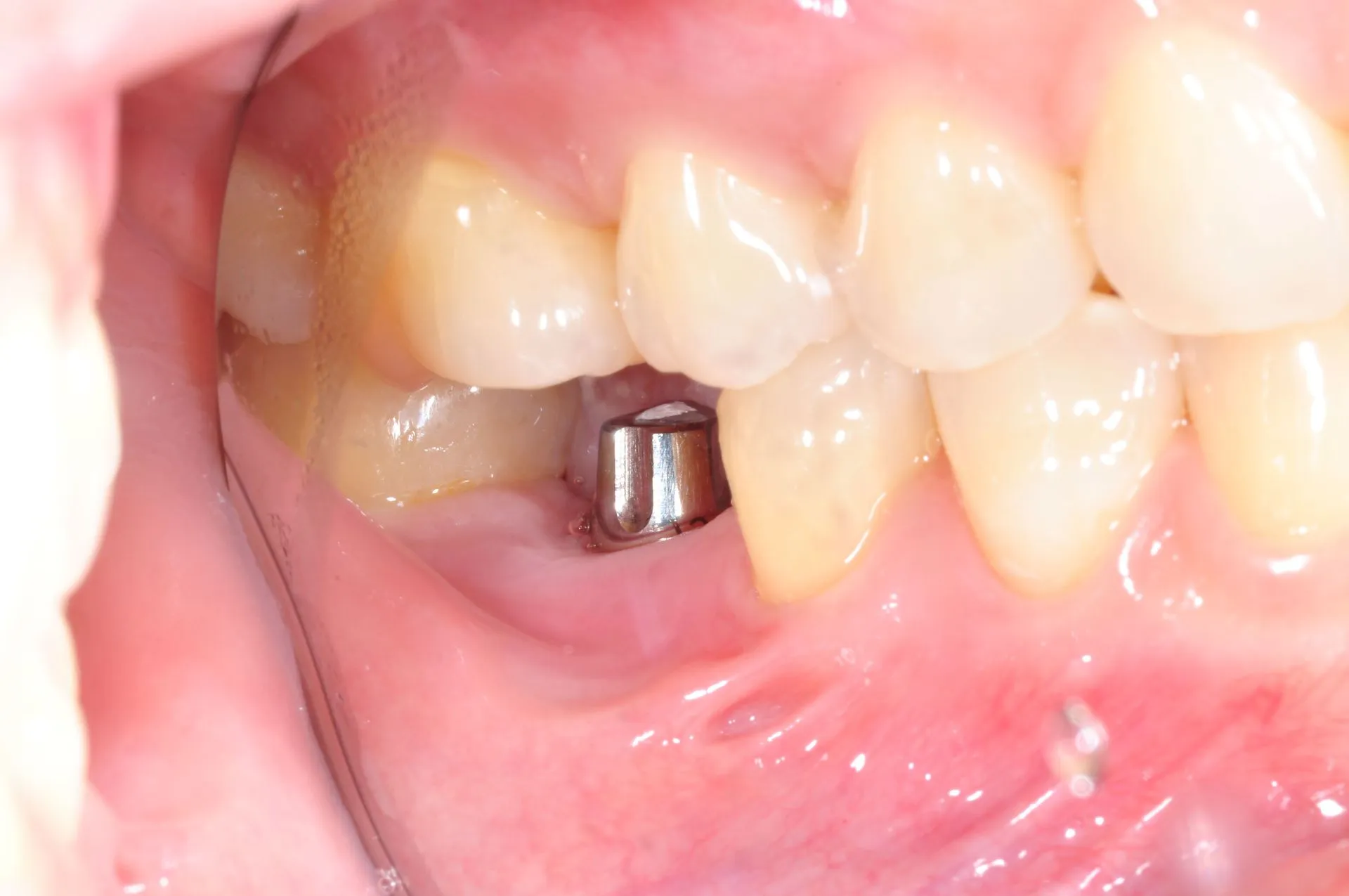 Mini Dental Implants