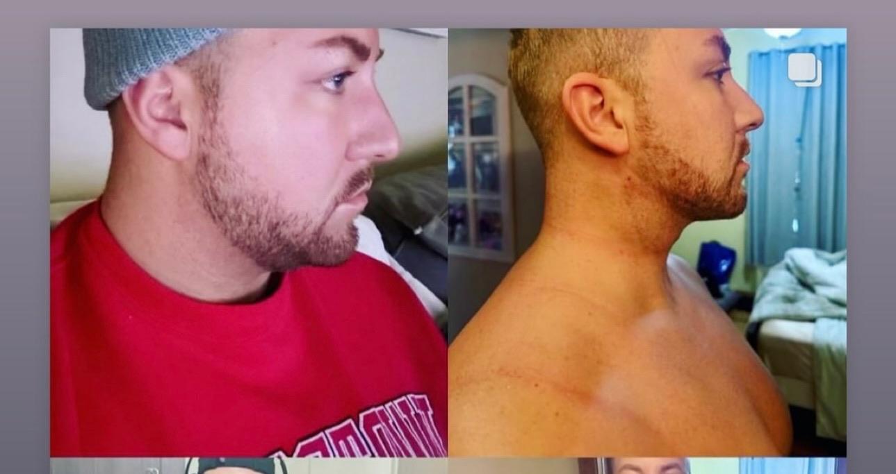 BodyLuxe | FormSculpt Awake Liposuction & Fat Transfer by Daniel J Farrugia MD PhD FACS Image