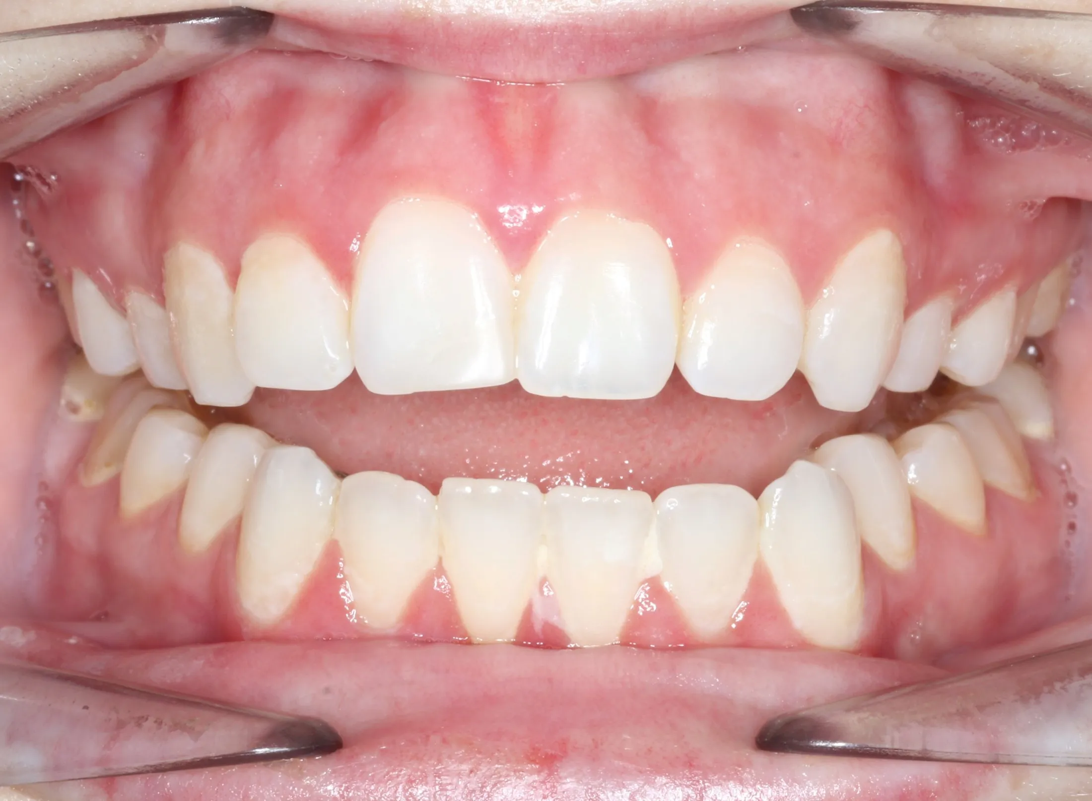 Idiopathic Condylar Resorption