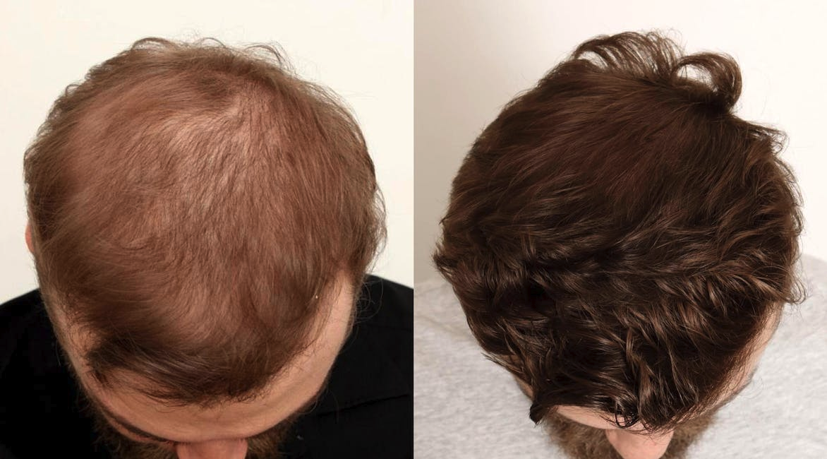 Hair Loss in Men