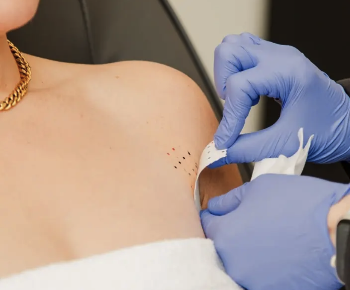 Kybella