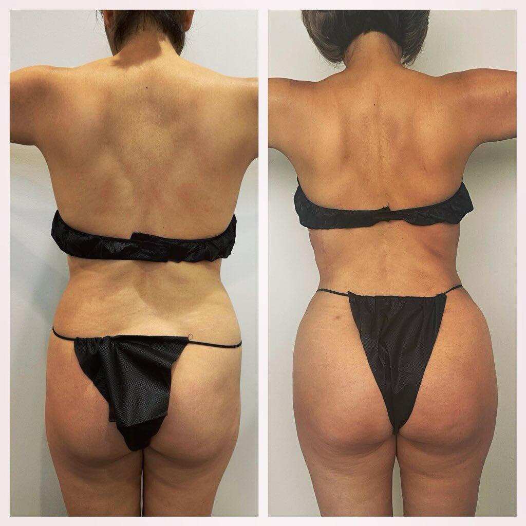 BodyLuxe | FormSculpt Awake Liposuction & Fat Transfer by Daniel J Farrugia MD PhD FACS Image