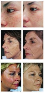 Photo Facials