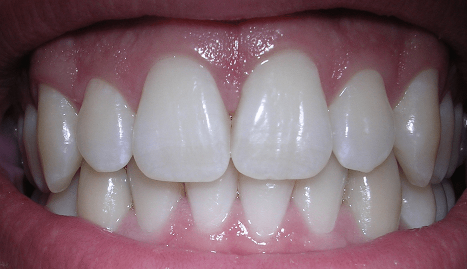 Dental Smile Makeover Photo