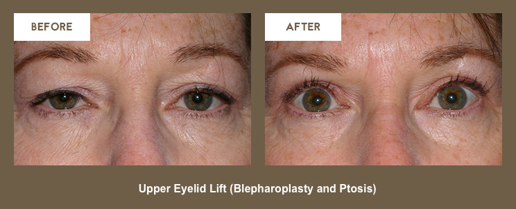 Klapper Eyelid and Facial Plastic Surgery Photo